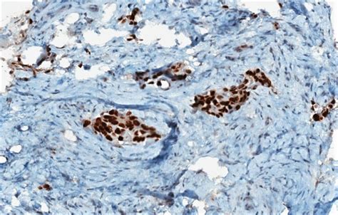 Spindle Cell Carcinoma Lung Chemotherapy