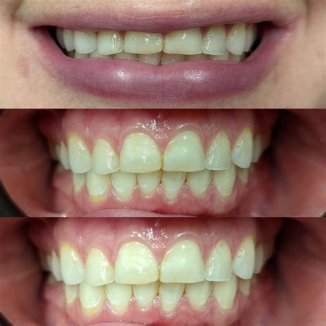 GLO Teeth Whitening Improves Patient’s Smile Better than OTC Treatments | Dentist in Leesburg, VA