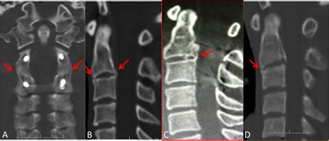 CT scans showing the spontaneous fusion of C2-C3: A spontaneous fusion ...