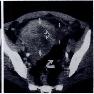 -A, Axial CT scan at level of low transverse incision shows loss of ...