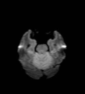 Acute Cerebillitis-MRI - Sumer's Radiology Blog