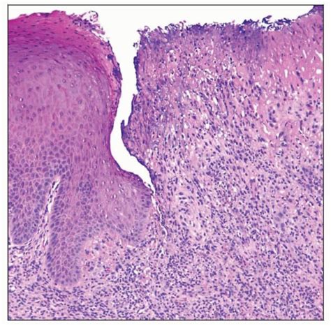 Aphthous Stomatitis Histology