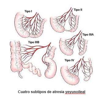 Atresia y estenosis intestinal | Tipos, diagnóstico y tratamiento