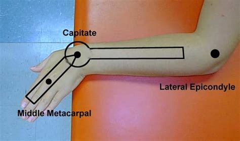 Ulnar deviation and ulnar drift definition and causes