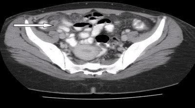 CT scan. The arrow points to a distended appendix with thickened walls ...