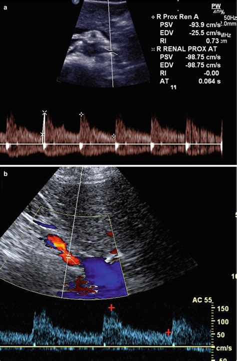 Color Duplex Scanning of the Renal Arteries | Thoracic Key