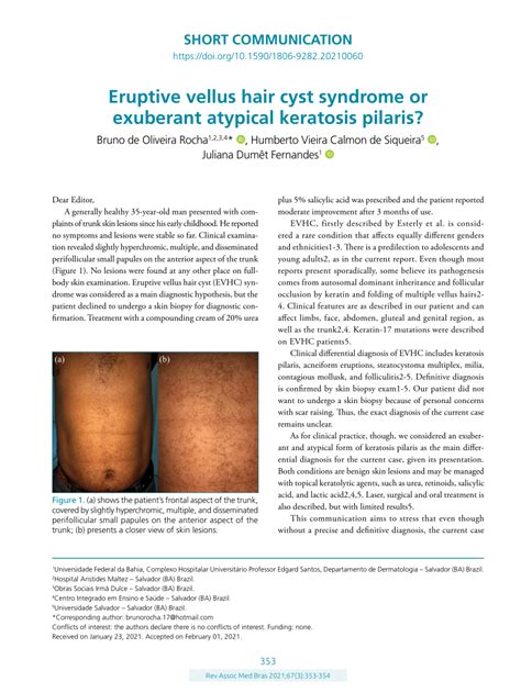 (PDF) Eruptive vellus hair cyst syndrome or exuberant atypical keratosis pilaris?