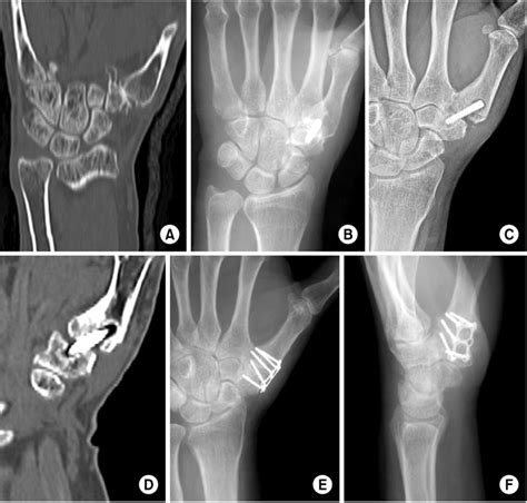 (A) CT shows fracture of trapezium and carpometacarpal joint... | Download Scientific Diagram