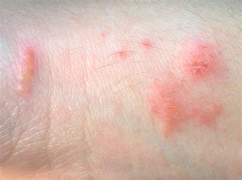 File:Poison ivy contact dermatitis.jpg - Wikimedia Commons