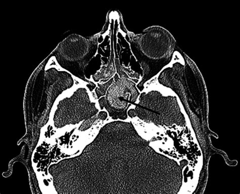 Axial CT sinus with soft tissue windowing in patient with features... | Download Scientific Diagram