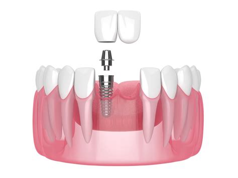 Cantilever Dental Bridge - Procedure, Pros, Cons & Costs