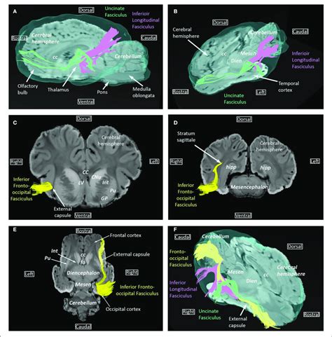 | Inferior longitudinal fasciculus, uncinate fasciculus, and inferior... | Download Scientific ...