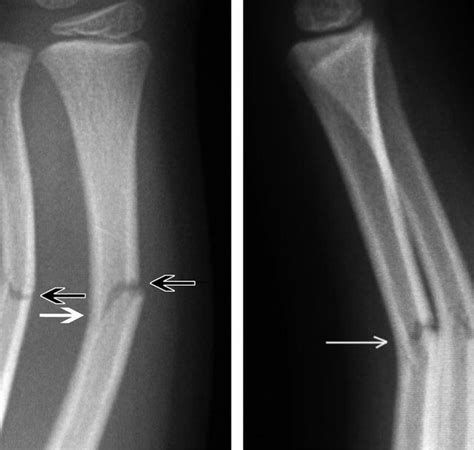 Greenstick vs Nightstick Fracture Difference, Symptoms, Causes, Treatment