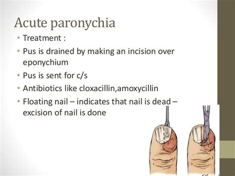 Acute Paronychia Treatment