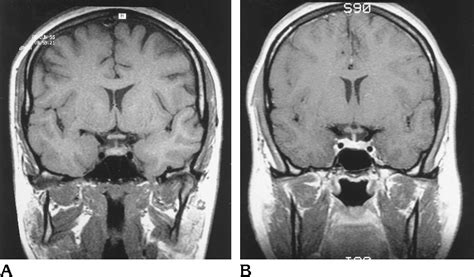 Figure 3 from Measurement of the normal optic chiasm on coronal MR images. | Semantic Scholar