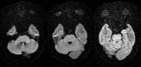 Dr Balaji Anvekar FRCR: Central Pontine Myelinolysis