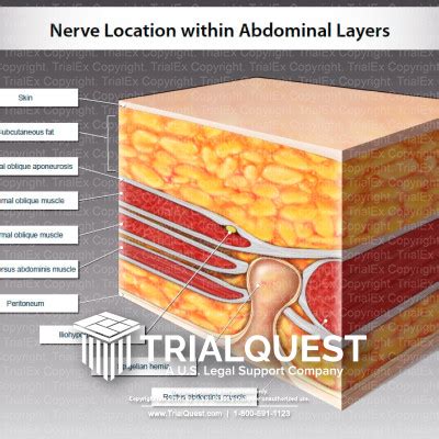 Medical Legal Exhibits - Legal Animations & Trial Graphics - Tria...