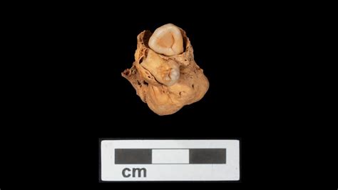 Tumor With Teeth Found In The Body Of A 3,000-Year-Old Egyptian Woman