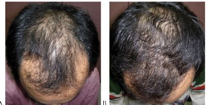 Finasteride Results: Timeline, Photos, Before & After