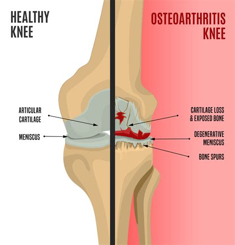 Turmeric for Arthritis | Curcumin for Arthritis