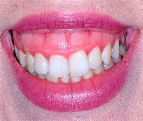 ESTÉTICA : ¿Cómo tratar la sonrisa gingival? - Directorio Odontológico