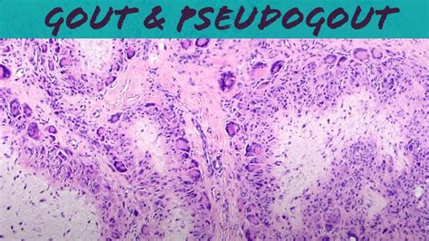 Gout Vs Pseudogout Crystals