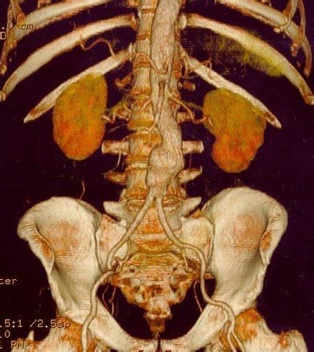 New cause of abdominal aortic aneurysm uncovered • healthcare-in-europe.com