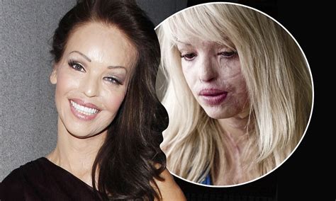 Katie Piper: Acid attack victim shows how far she's come at TV Choice ...