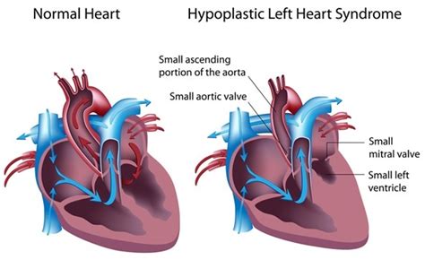 Causes and Symptoms of Hypoplastic Left Heart Syndrome