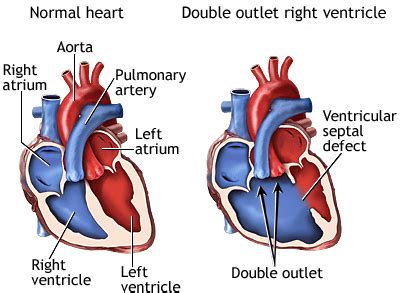 Double Outlet Right Ventricle (DORV) Surgical Planning