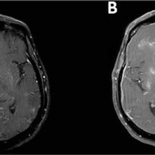 MRI Brain: showing ring enhancing lesions before (A) and after (B) the... | Download Scientific ...