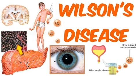 Wilson's Disease! | Wilson's disease, Disease, Hereditary diseases