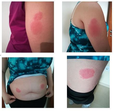 An Unusual Case of Allergic Reaction to Anakinra in a Patient with ...