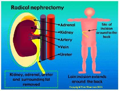 Radical removal of the kidney: procedure specific information | CUH