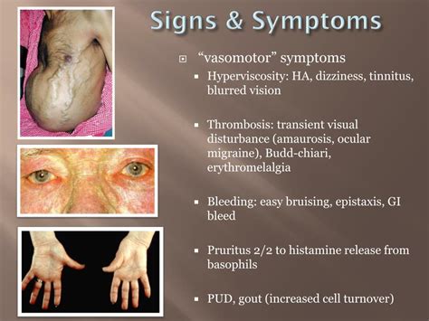 PPT - Polycythemia vera PowerPoint Presentation, free download - ID:7007827