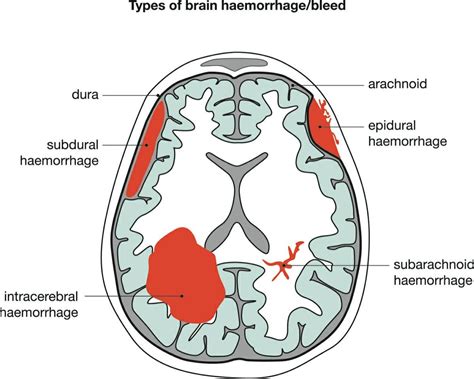 Types Of Brain Hemorrhage Surgery - Peter Brown Bruidstaart