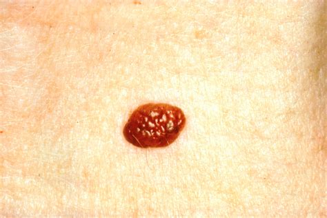 Pictures Melanoma Skin Cancer Moles