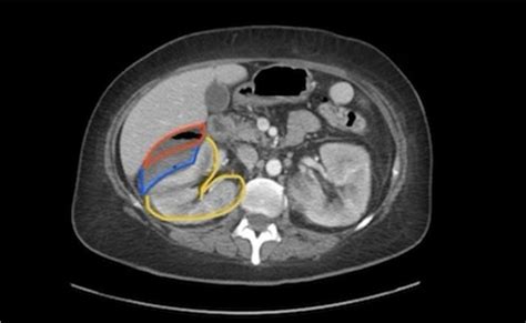 Emphysematous pyelonephritis. CT Transverse, Annotated. JETem 2023 - JETem