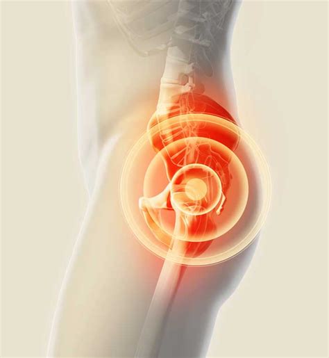 Ischiofemoral Impingement | Ischium Pain | Nashville, TN