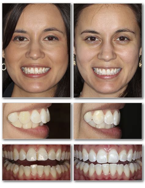 Invisalign Before and After — Invisalign Studio