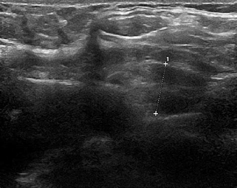 Ultrasound neck image illustrating the parathyroid adenoma measuring 11 ...