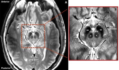 mri_substantia_nigra_brain – Journey with Parkinson's