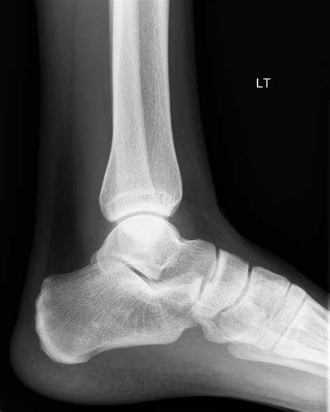 Ankle effusion - teardrop sign | Image | Radiopaedia.org