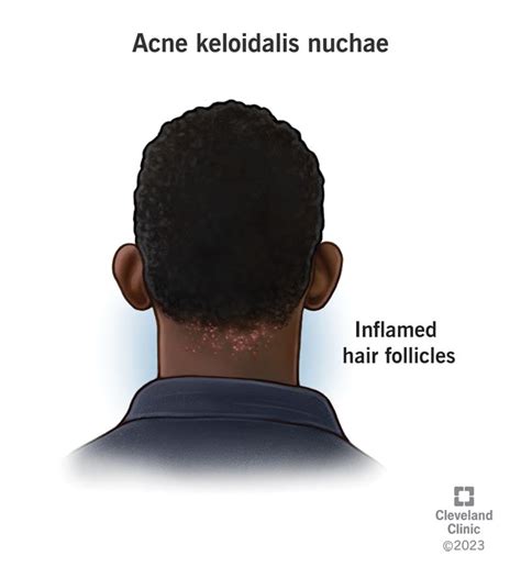 Acne Keloidalis Nuchae: What It Is, Causes & Treatment