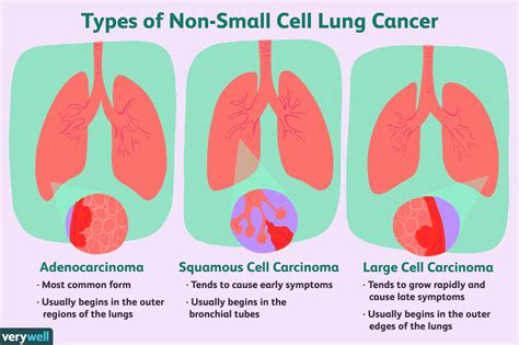 Cancer du poumon à un stade précoce : Vue d'ensemble et plus encore