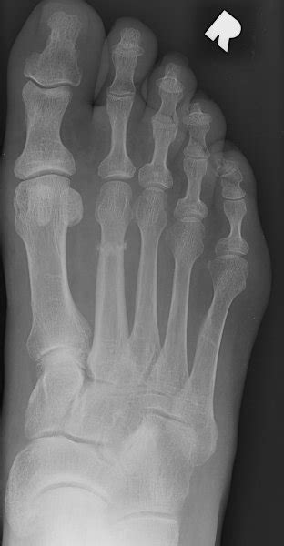 Metatarsal Bone Fracture