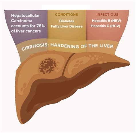 Liver Cancer — Cancer Prevention and Research Institute of Texas