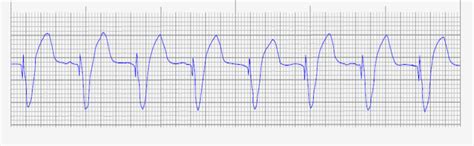 ventricular-pacing - Cardiac Sciences Manitoba