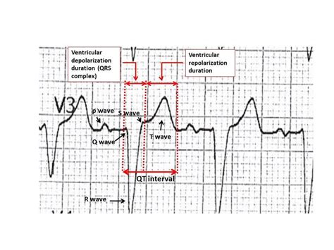 The illustrations of ventricular depolarization and repolarization ...