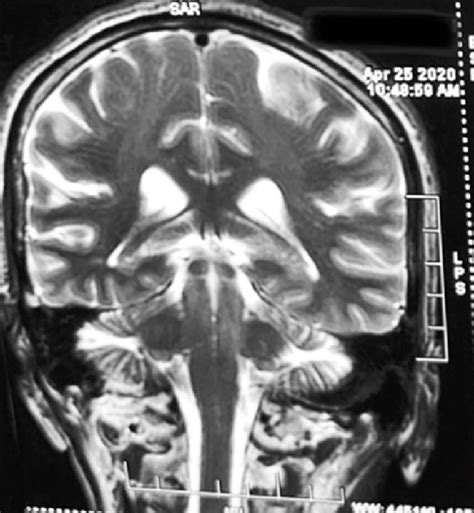 Coronal view of MRI brain showing bilateral occipital, parietal cortex ...